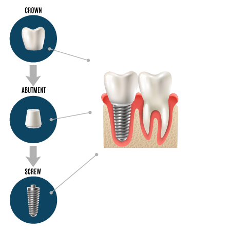 Dental Implants in Temple Terrace